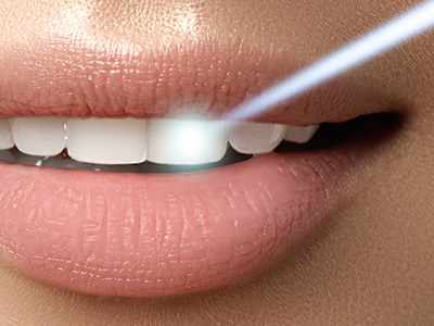 Delgado Dental Group | Juvederm reg , Dental Sealants and ZOOM  Whitening